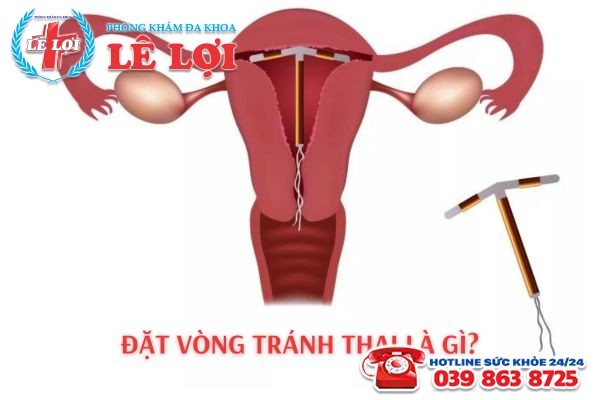 Đặt vòng tránh thai là phương pháp ngừa thai được sử dụng phổ biến