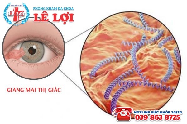 Bệnh giang mai thị giác do xoắn khuẩn Treponema pallidum gây ra