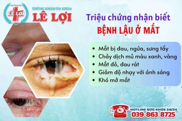 Dấu hiệu nhận biết bệnh lậu ở mắt