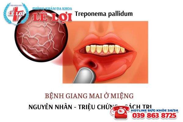 Giang mai ở miệng: Nguyên nhân, triệu chứng và cách điều trị