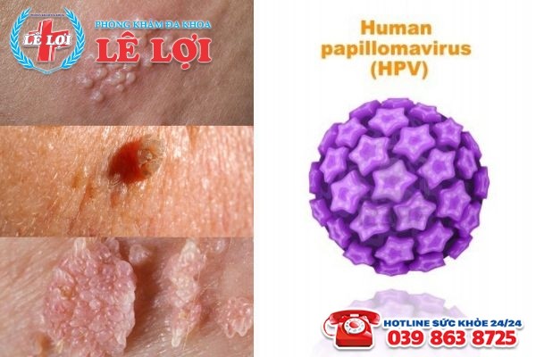 Virus HPV là tác nhân lây nhiễm bệnh sùi mào từ người sang người