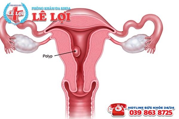 Bệnh polyp tử cung ở nữ giới