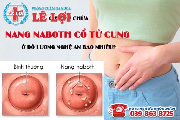 Chi phí chữa nang naboth cổ tử cung ở Đô Lương Nghệ An