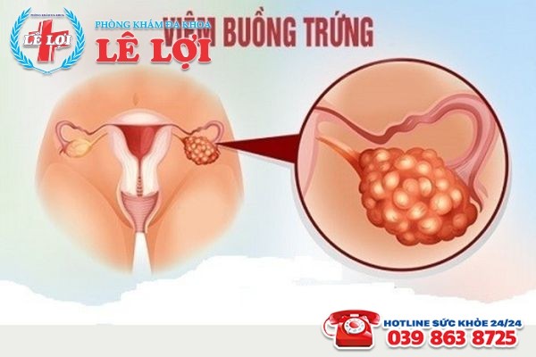 Viêm buồng trứng là bệnh lý phụ khoa thường gặp ở nữ giới
