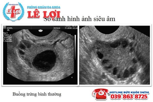 Những hình ảnh siêu âm buồng trứng đa nang ở nữ giới