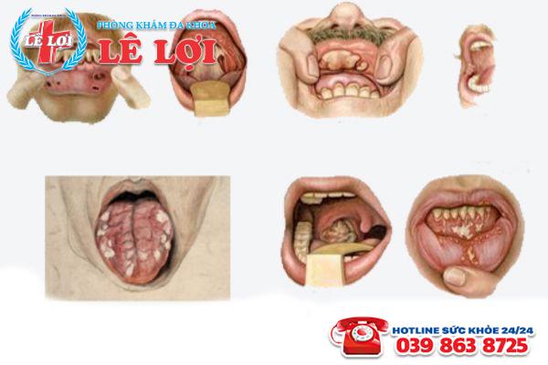 Triệu chứng giang mai ở miệng giai đoạn đầu
