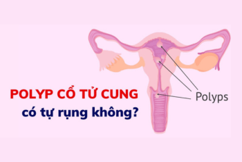 Polyp cổ tử cung có tự rụng không?