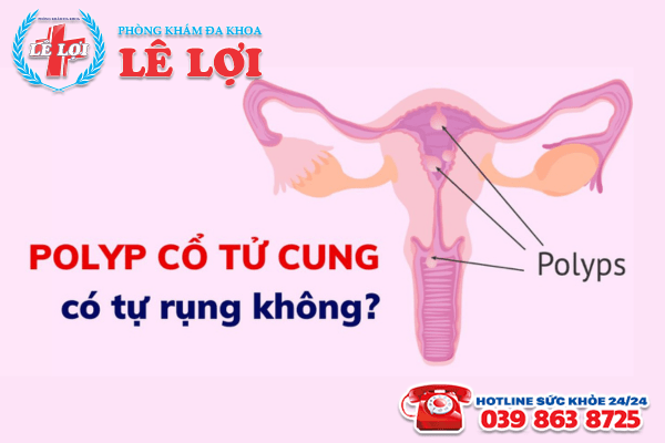 Polyp cổ tử cung có tự rụng không?