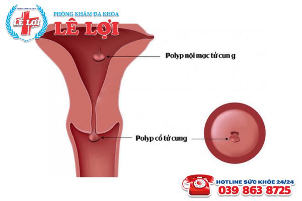 Polyp cổ tử cung là gì?