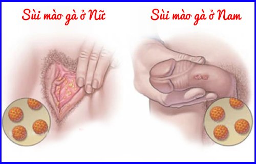 Triệu chứng sùi mào gà ở nam và nữ